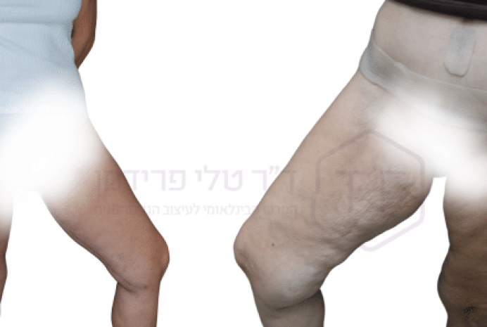 הסרת עודפי עור בירכיים לפני ואחרי